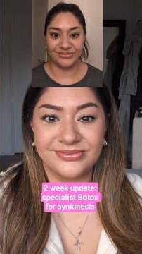 2 week Botox update in the description 💉