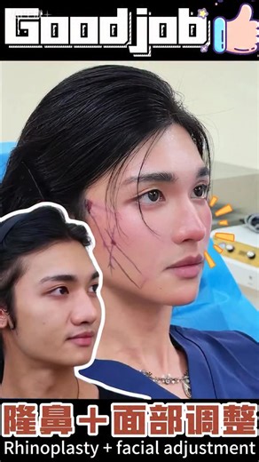 dr.rhinoplasty陈杰 on Instagram‎: "Here’s a before-and-after video of a man’s rhinoplasty and facial contouring surgery! Do you think he looks much different after the procedures? If you’re interested, you can add me to schedule an online consultation 👇 http://api.whatsapp.com/send/?phone=886919141153&text=Hi,Dr.Chen #rhinoplasty #鼻整形 #隆鼻 #鼻子 #nose #鼻整形ダウンタイム #鼻修复 #隆鼻術 #การผ่าตัดเสริมจมูก #تجميل #鼻综合 #面部提升 #抗衰 #抗衰老 #拉皮 #帅哥 #新加坡 #nosejob #nosejobs #nosesurgery #rhinoplastie #rhinoplastic #3d #face