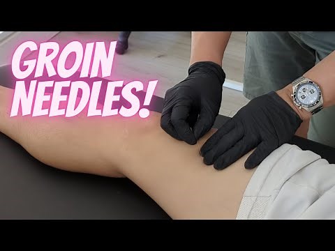 🦵🏼 POKING THE GROIN - Adductor Muscle Dry Needling (Quick Demo)