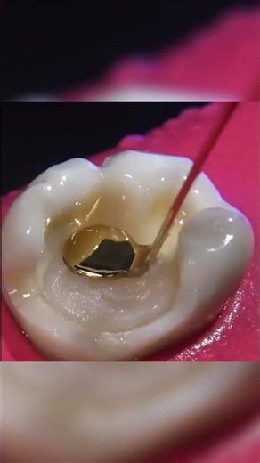 How Cracked Tooth Got Repaired?🤔