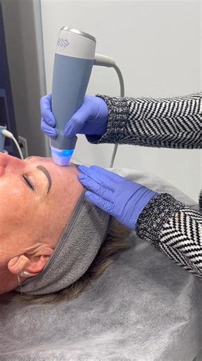 Watch Dr. Kaur perform EXION Fractional RF Microneedling on the face and neck while explaining how the treatment works—and why patients love it. This is our patient’s second session, and she’s already seeing a major improvement in skin texture and overall quality after just one treatment. She has two sessions to go, and the collagen-building process is well underway. EXION RF Microneedling is known for: ✔️ Proven safety ✔️ Minimal to no downtime ✔️ Improved tone, texture & firmness ✔️ Visible re