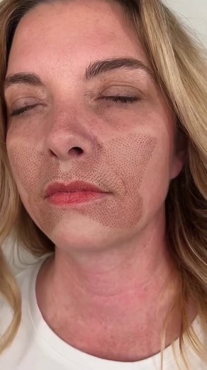 1K views · 153 reactions | 曆Plasma Lift Butterfly Lift曆 Plasma Lift...