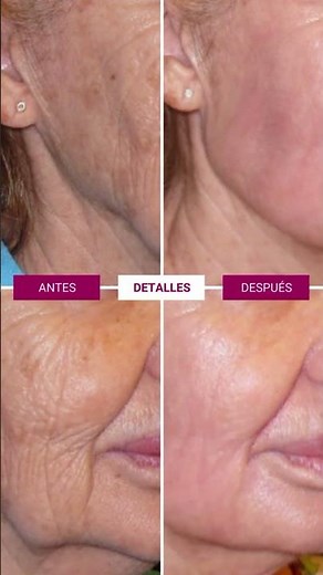 Láser CO2 caso antes y después