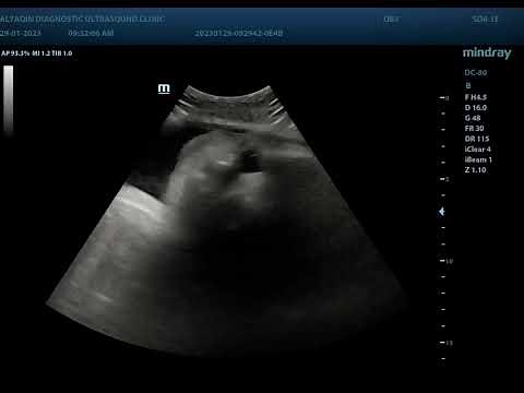Cleft lip and palate ultrasound