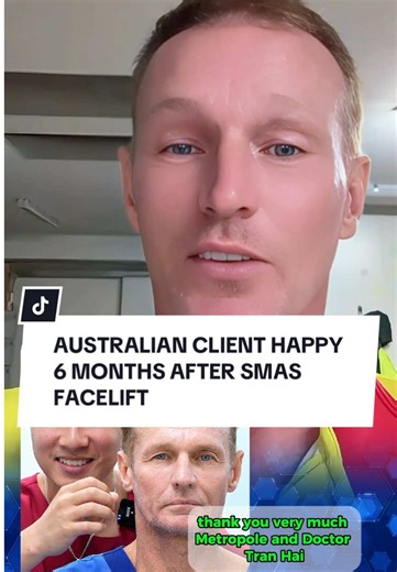 Australian Client Thrives 6 Months After SMAS Facelift