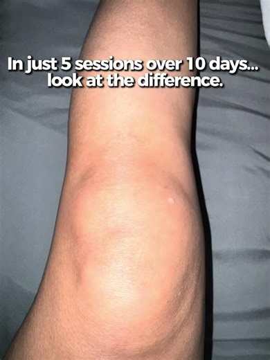 Bioflex recovery