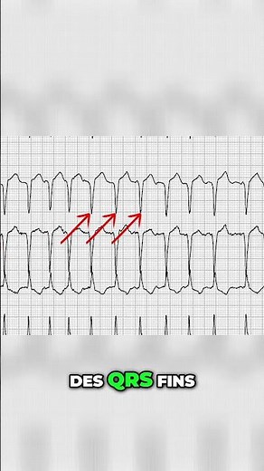 Comprendre la Fibrillation Auriculaire Onde P et QRS