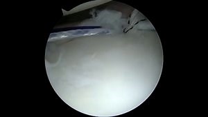 360 Degree Labral Repair with all Knotless Anchors
