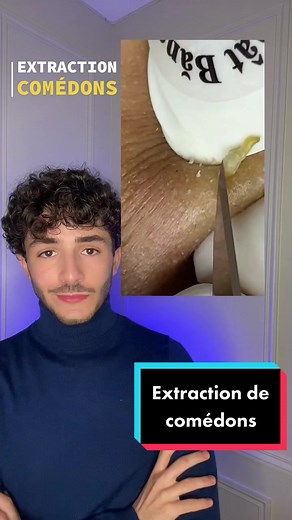 ✅ 10/10 pour cette extraction de comédons très satisfaisante 😩 @Skincare By Samy 🔬Les points noirs sont une accumulation de sebum qui reste coincé dans les pores de la peau. Au contact de l’air ce sébum s’oxyde et noircit (comme une pomme) et c’est ce qu’on appelle un point noir. 🧪 Pour éviter ces points noirs il faut utiliser de l’acide salicylique qui pénètre les pores et les libère du sébum accumulé 👍🏻 #skincare #pointsnoirs #blackhead #satisfying #satisfyingvideo #blackheadremoval #blac