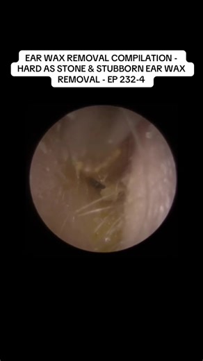 EAR WAX REMOVAL COMPILATION - HARD AS STONE & STUBBORN EAR WAX REMOVAL - EP 232-4#removal