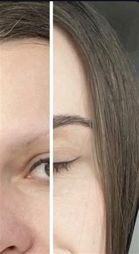 Пересадка бровей результат #пересадкаволос