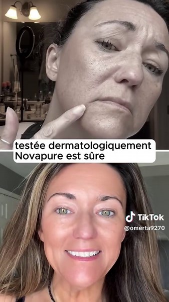 🌟 Dites ADIEUX aux rides et RÉVEILLEZ l'éclat de votre peau ! 🌟 Offrez à votre peau le luxe qu’elle mérite avec Novapure Micro-Infusion, la technologie de beauté ultime pour un teint éclatant et rajeuni. ✨ Grâce à ses micro-aiguilles plaquées or, cet appareil révolutionnaire libère des nutriments puissants directement dans les couches profondes de votre peau, sans besoin de traitements invasifs. Le résultat ? Une peau visiblement plus jeune, des rides et ridules atténuées, des pores resserrés 