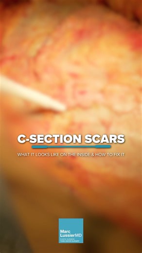 Fixing a C-Section Scar During a Tummy Tuck Procedure #csectionscar #tummytucksurgery
