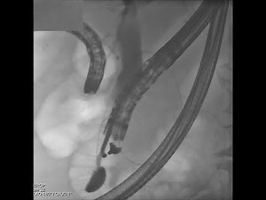 Frustrane ERCP, Rendezvous Technik