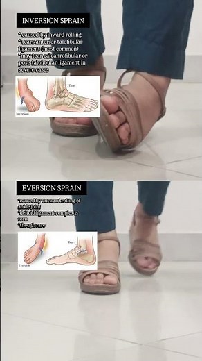 Understanding ankle sprains: Inversion sprains occur when the foot rolls inward, often affecting the