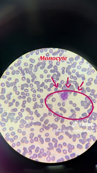 Understanding Monocytes in Blood Smears
