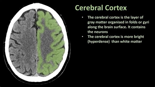 如何阅读脑部CT（第二部分）：CT上的脑部解剖