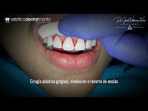 Recorte de encias. Cirugia plástica gingival. Gingivectomía. Diseño de sonrisa.