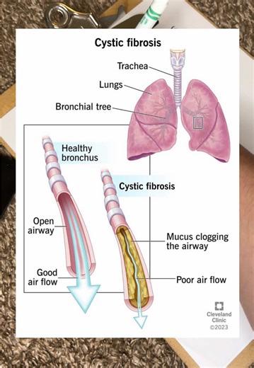 Learn about the basics of Cystic Fibrosis in less than 1 minute!!! Cystic Fibrosis is a rare genetic disease in which mucous and other body products do not contain enough water or salts. This results in lots of frequent infections along with other long term impacts. I am learning about CF in a lecture this week. I am not an expert. Just a girl with an interest in genetic conditions with a passion for awareness and research. Resources: Drbeen Medical Lectues on YouTube, www.csf.org. As a person w