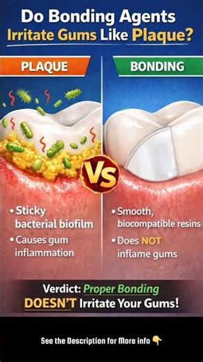 🦷 Do Bonding Agents Irritate Gums Like Plaque?