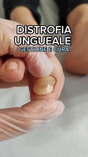 ⬇️Sono definite unghie distrofiche tutte quelle unghie che hanno un aspetto anomalo, con cambiamenti di consistenza, colore o spessore della lamina ungueale. 🤌Le cause possono essere diverse. tra le più comuni abbiamo : 🍄- Distrofia micotica. Quella causata da infezione micotica, cioè da fungo patogeno. 📉 È la MENO comune! 🩺- Distrofia da trauma cronico come ad esempio avviene in chi soffre di alluce valgo, alluce rigido, dita a martello ed Artiglio e altre problematiche di deformità delle d