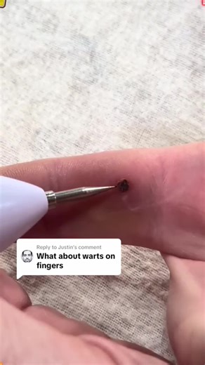 Tattoo Removal Techniques: Exploring Beauty Pen Options