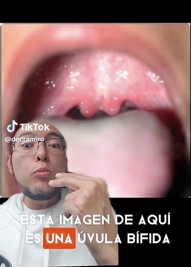 Úvula Bífida: Significado, Tipos y Tratamiento