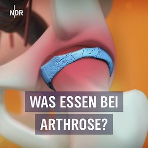 Probleme mit Rheuma oder Arthrose? Richtige Ernährung kann eine wirksame Waffe gegen Entzündungen im Körper sein! ------------------------------------- Neue Folgen E-Docs, montags um 21 Uhr ➡️ http://bit.ly/2Bl1sn7 | NDR Fernsehen