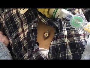胃ろうの手順