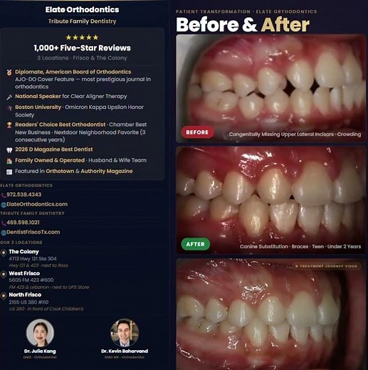Missing Lateral Incisors? Implants vs. Canine Substitution Explained