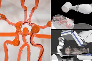 MIT engineers built a robot for emergency stroke surgeries – Lifeboat News: The Blog