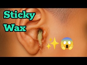 Massive Earwax Removed — Instant Relief!