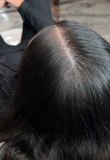 Crown Area SMP Case Study: Gentle Hair Density Approach
