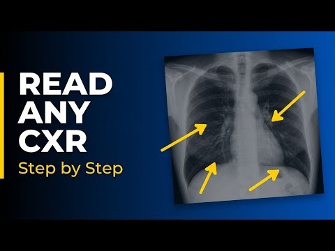 How to Read a Chest X-Ray: Step by Step for Beginners 