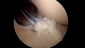 Bankart Lesion Repair Using Knotless Suture Anchors for Shoulder Instability - Part 1