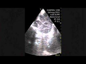 Retroperitoneal Lymphadenopathy • Video • MEDtube.net