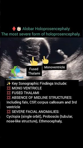 Ultrasound Fetal Anomaly: Alobar Holoprosencephaly
