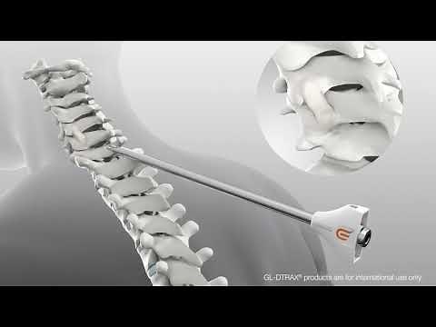 Posterior Cervical Fusion with GL DTRAX® Spinal System & GL DTRAX® Cervical Cage SE
