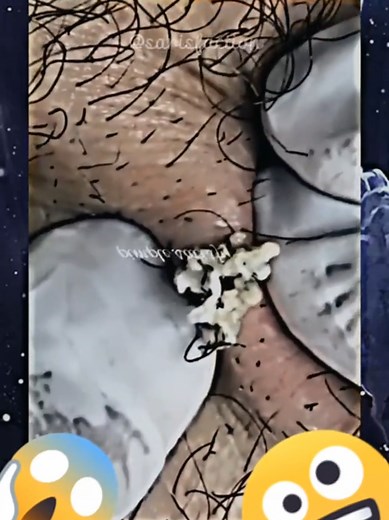 💥🤩 Dr. Sarisfaction 🤩💥 Watch Me Pop The Biggest Blackheads and Pimples Ever 🎥 🚀✨ You Won’t Believe The Results 😱 Like, Comment and Share If You Enjoyed This Video 💖 Follow Me For More Amazing Extractions 🔥 #skincare #beauty #pimplepopping #blackheadremoval #whiteheadremoval #zits #acne #skin #selfcare #satisfying #asmr #pimple #pimples #acneremoval #cyst #blackhead #whitehead #blemish #zit #rosacea #eczema #psoriasis #skincareroutine #skincaretips #skincareaddict #selfcare #satisfying #