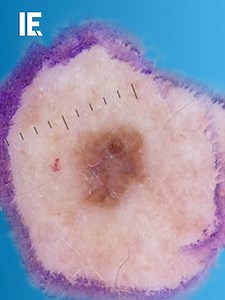 Device Detects Hidden Skin Cancers for Early Intervention