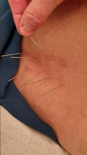 Relief from SEVERE back Pain | - Treatment from TOP acupuncturist in UK! #backpain