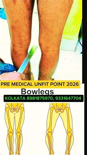 BOW LOGS MEDICAL UNFIT POINT #bowlegs #premedical #medicaltest #shorts #viral #sscgd2026 ssscgd