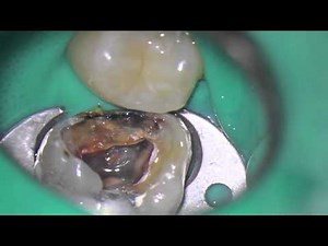 Access cavity 2 - The build up