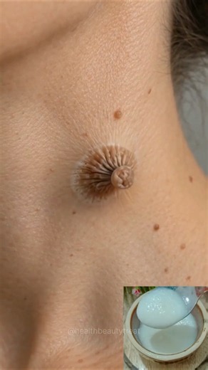 Remove Skin Tag Naturally At Home | Skin Tag & Wart Removal Easy Remedy #tags #skincare #shorts