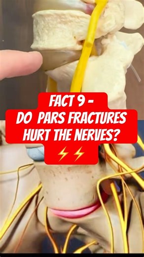 Pars Fracture made simple (by a spine surgeon;Fact 9 of 10)