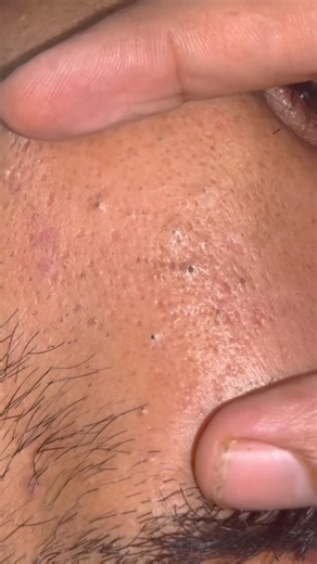 sac be spa blackhead elderly men face | sac be spa men face information | new sac be spa #555