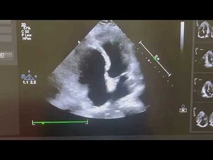 EBSTEIN’S ANOMALY OF TRICUSPID VALVE ECHO