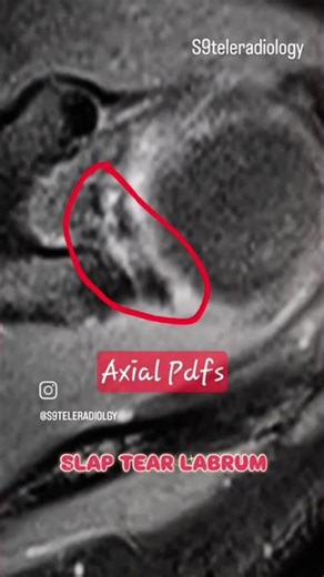SLAP Tear Shoulder #SLAPTear #ShoulderMRI #MSKRadiology #SportsInjury #radiology #mri ##jointpain