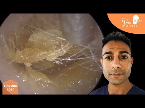 1,064 - Complete Ear Wax Blockage Removal