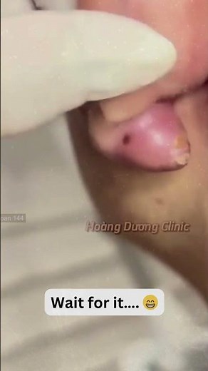 Large Blackheads Extraction Big Cystic Acne Blackheads&Whiteheads Removal Pimple Popping #1125 2026